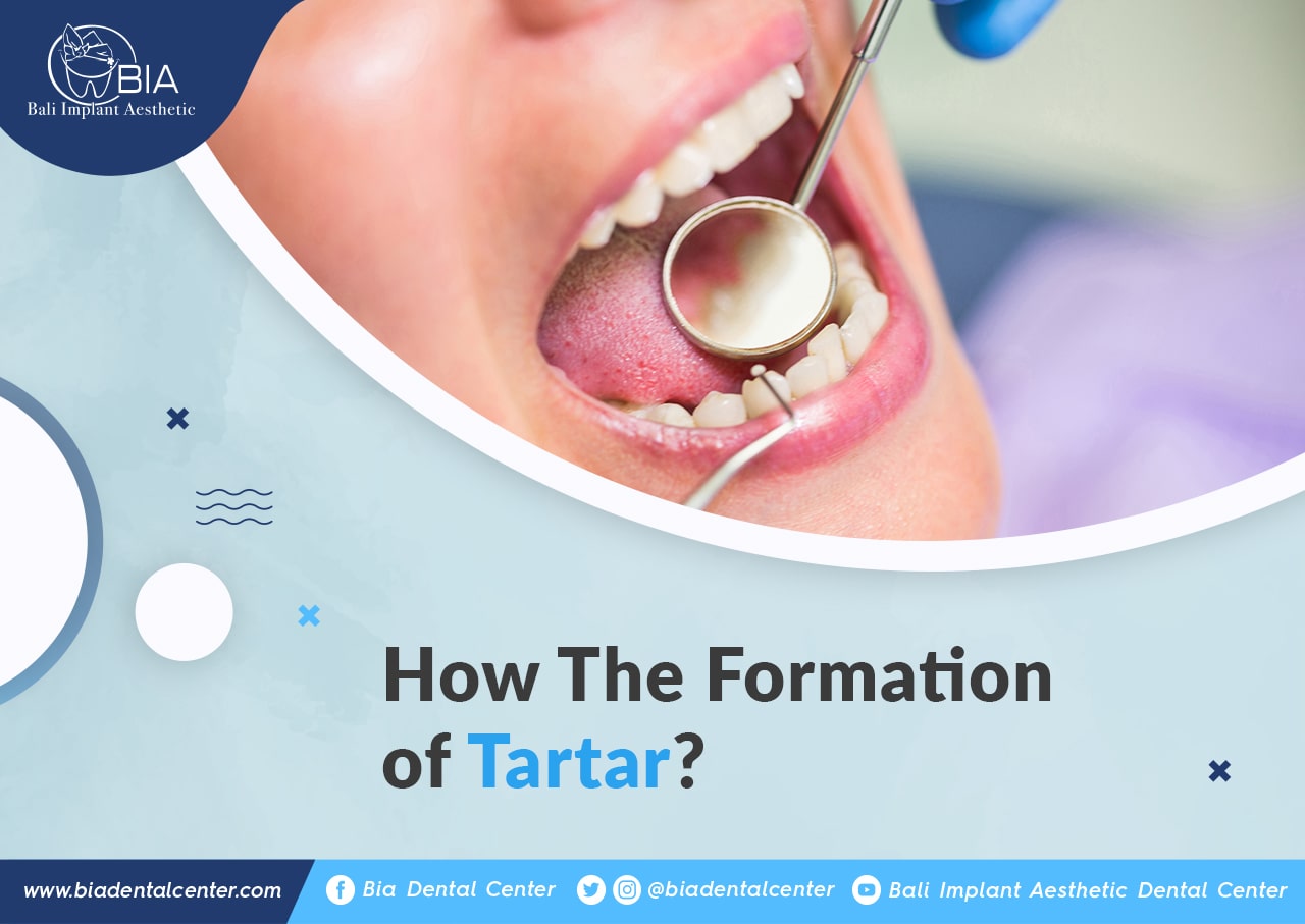 Blog Article Bia Dental