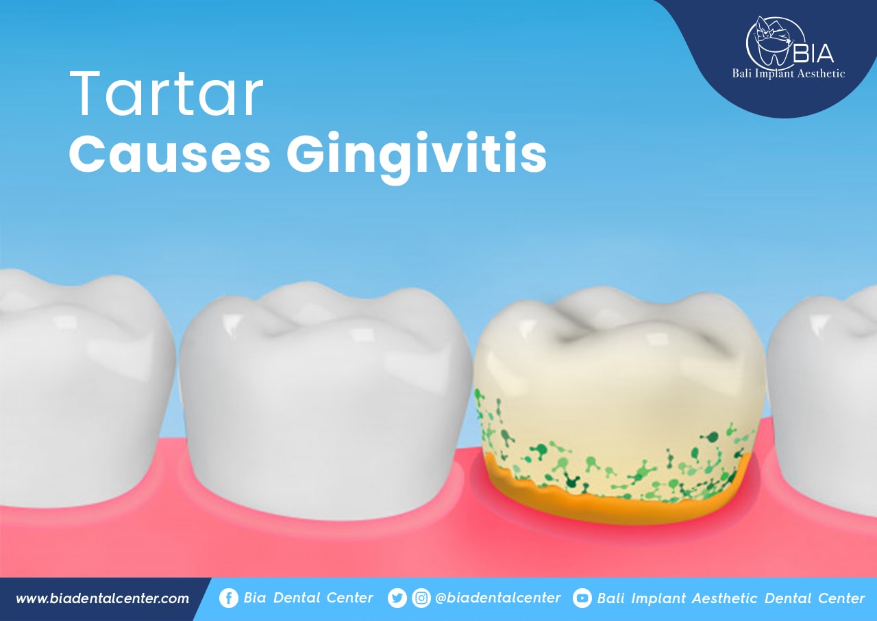 Blog Article Bia Dental