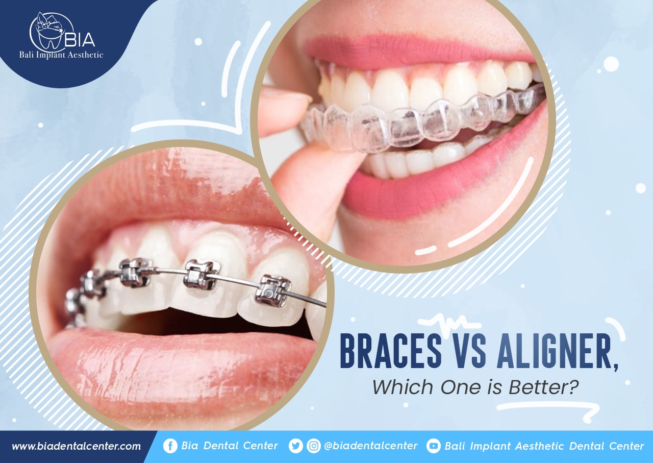Blog Article Bia Dental