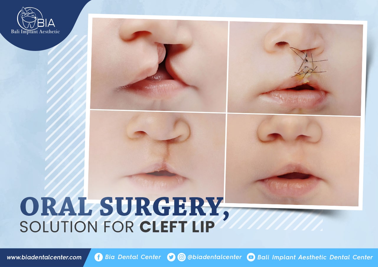 Blog Article Bia Dental