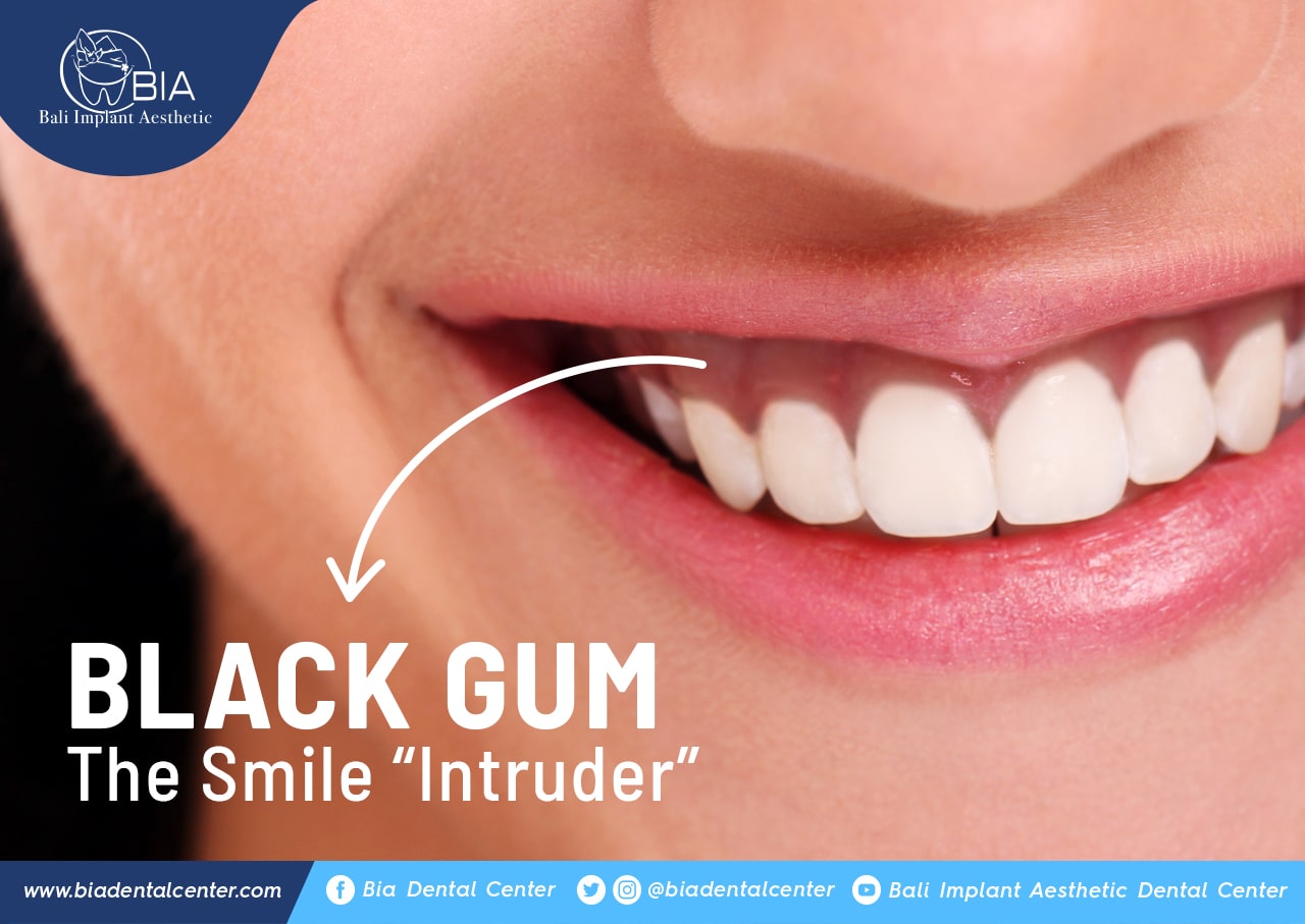 Blog Article Bia Dental