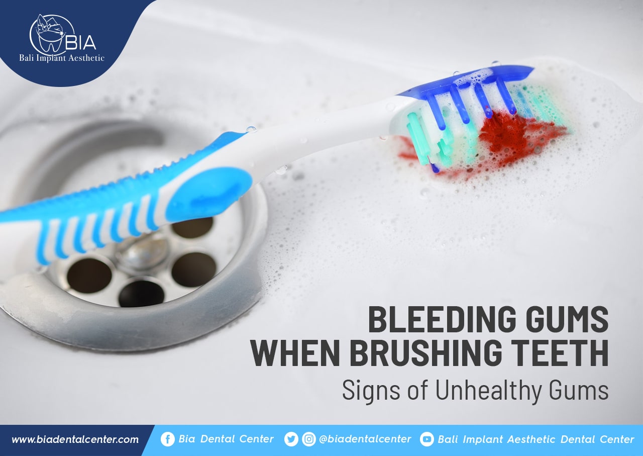 Blog Article Bia Dental