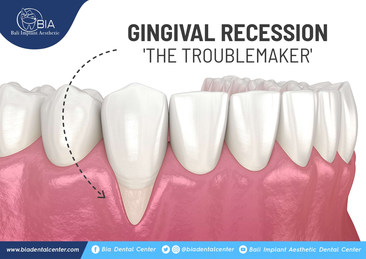 Blog Article Bia Dental