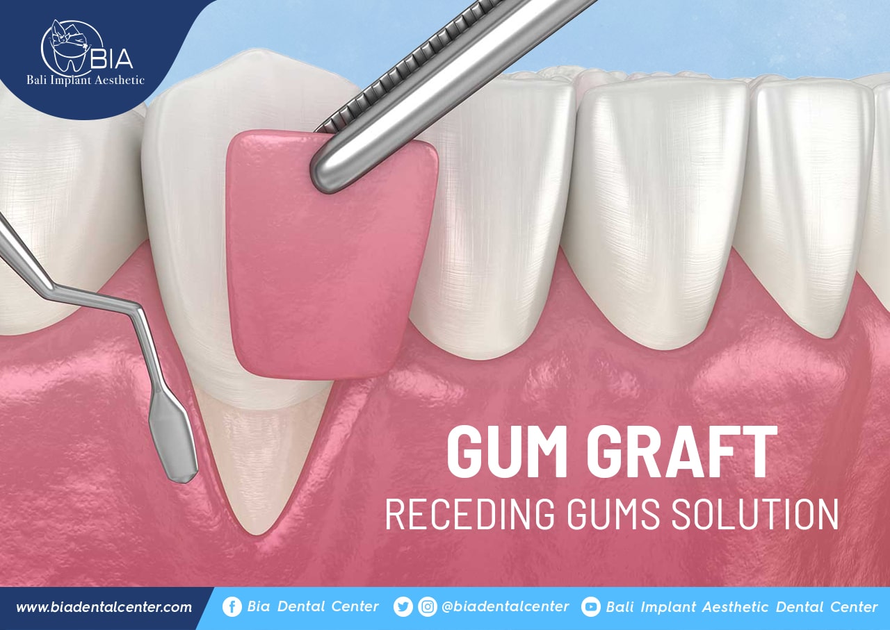 Blog Article Bia Dental