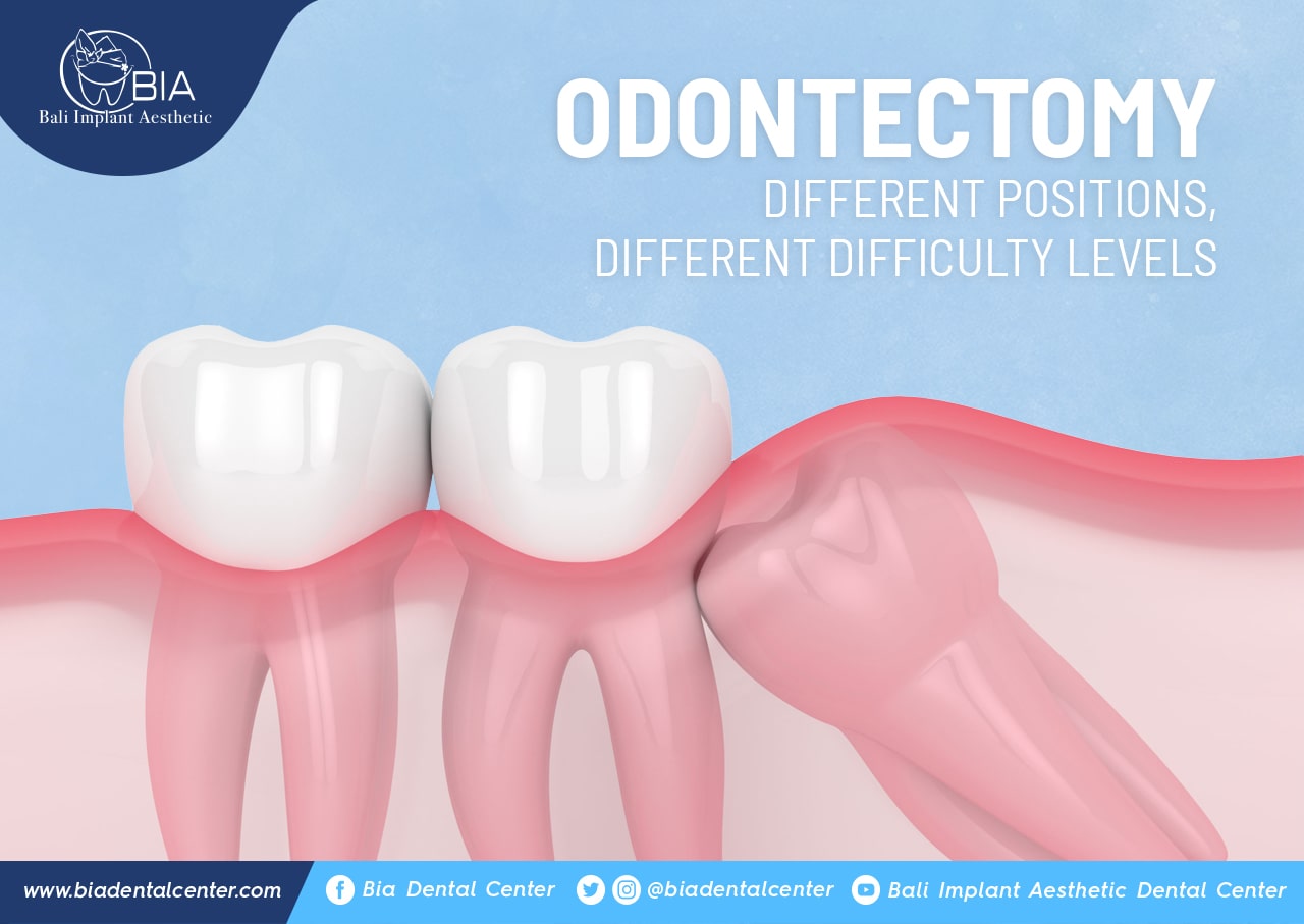 Blog Article Bia Dental