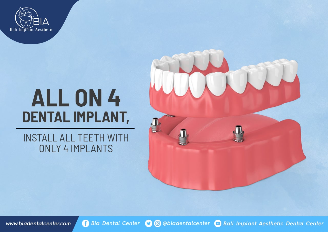 Blog Article Bia Dental
