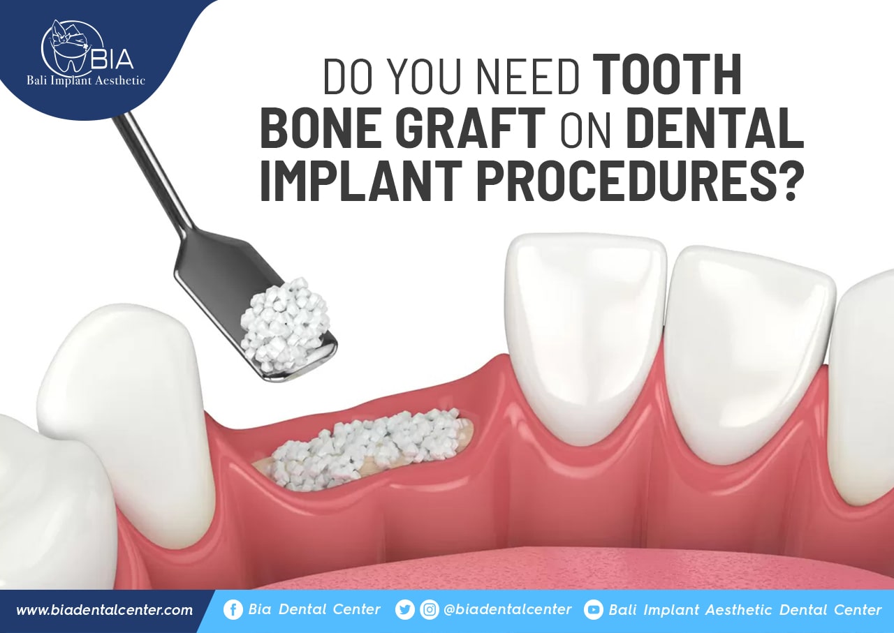 Blog Article Bia Dental