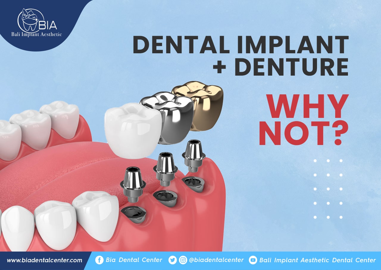 Blog Article Bia Dental