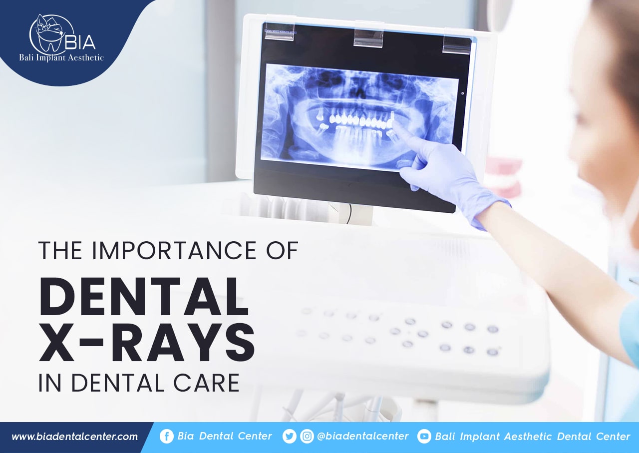 Blog Article Bia Dental