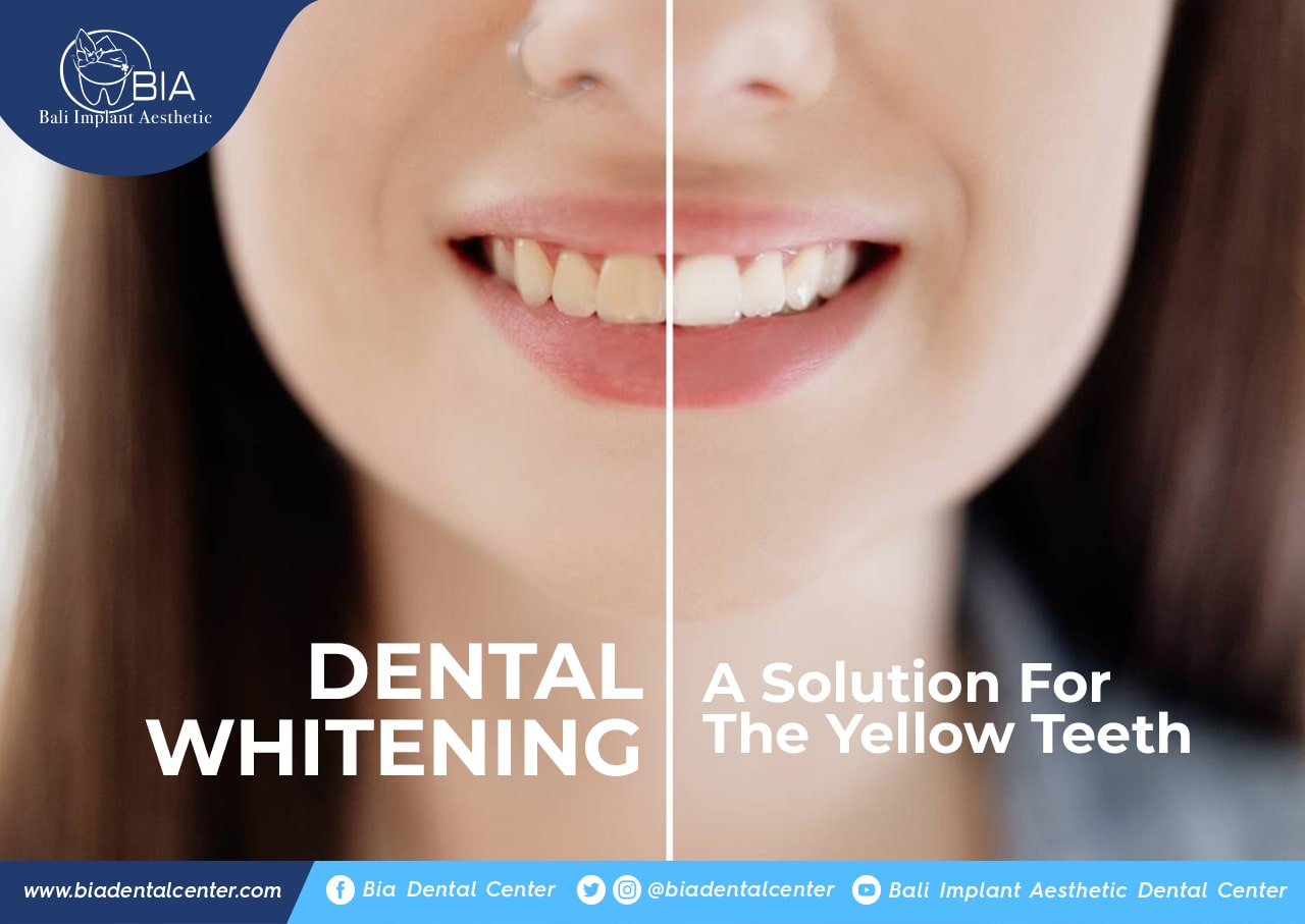 Blog Article Bia Dental