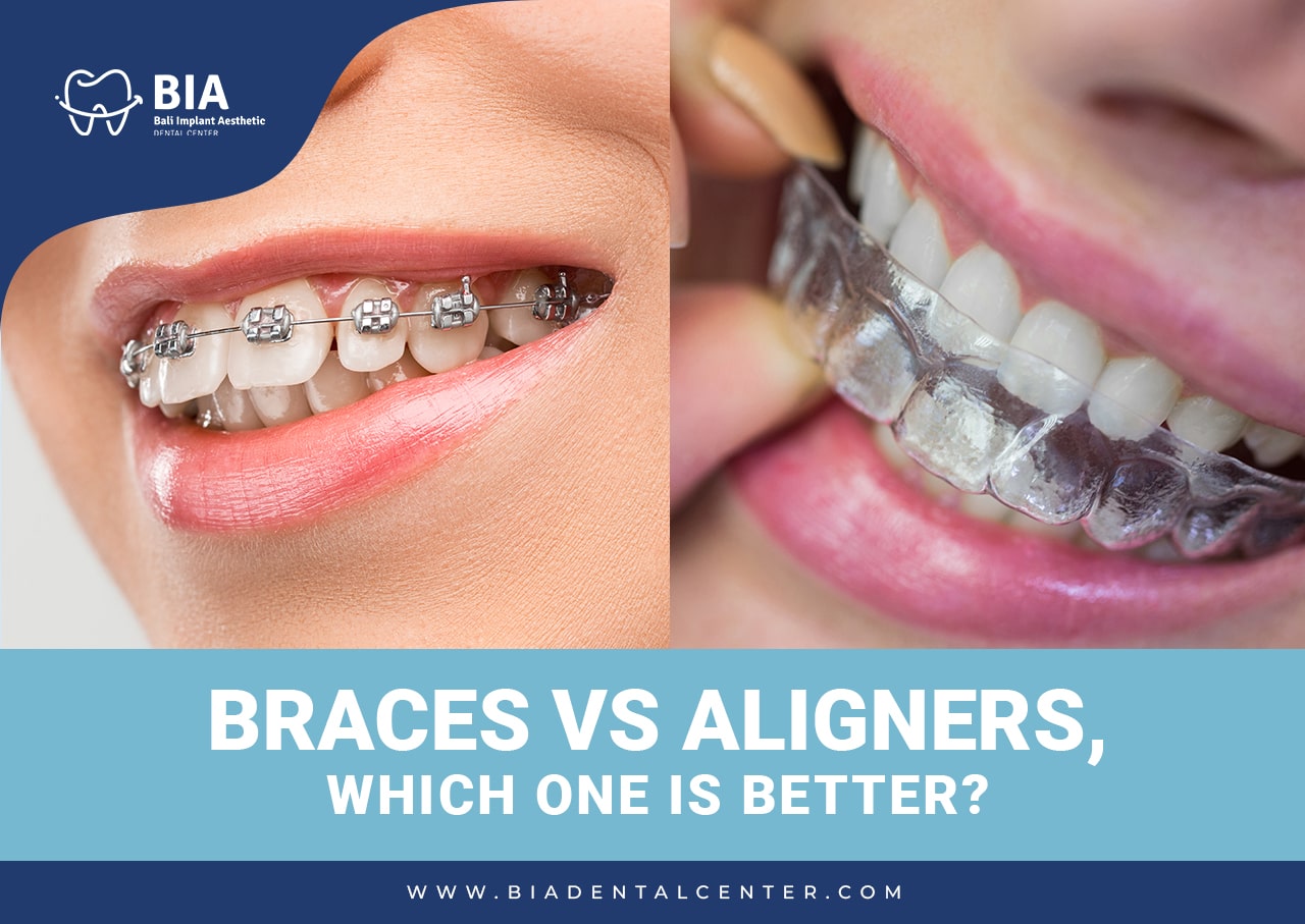 Blog Article Bia Dental