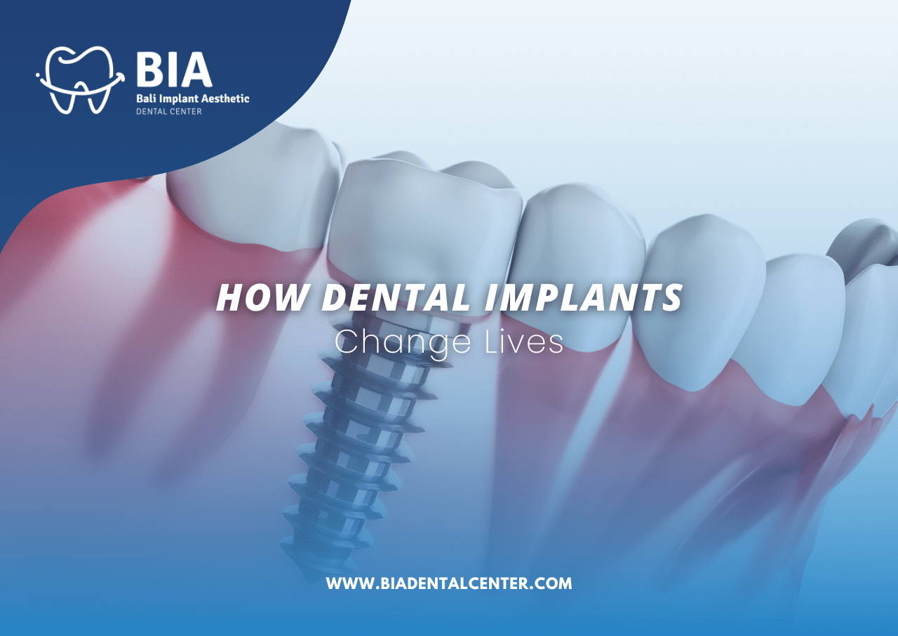 Blog Article Bia Dental