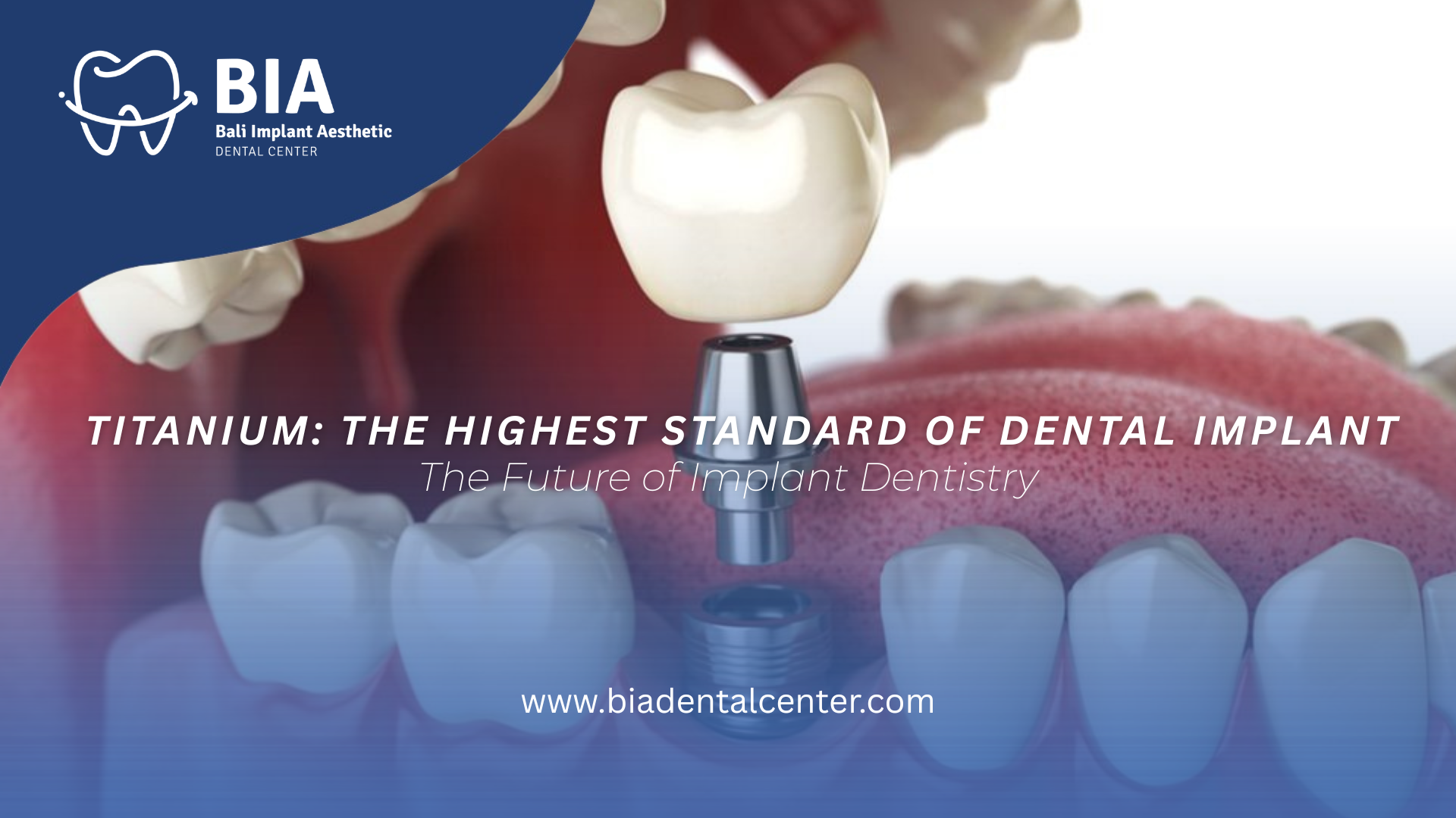Blog Article Bia Dental