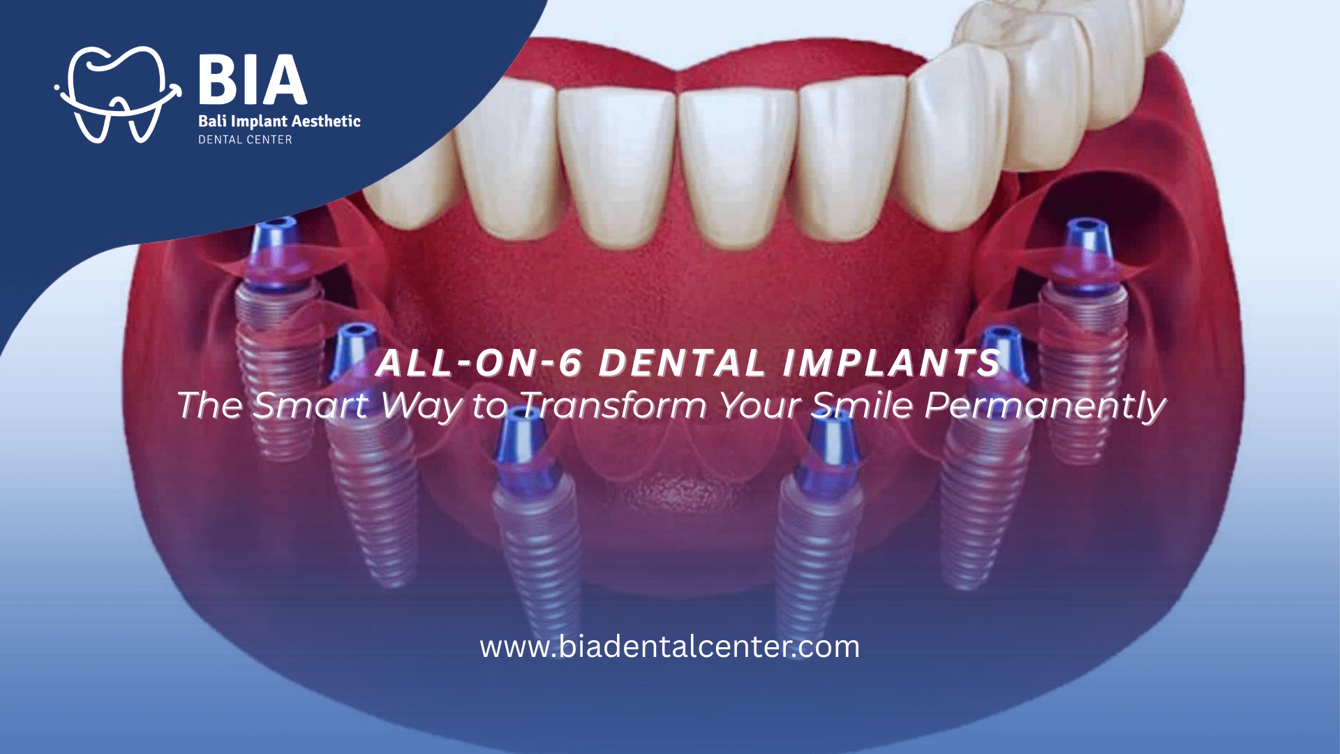 Blog Article Bia Dental