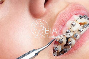 Blog Article Bia Dental