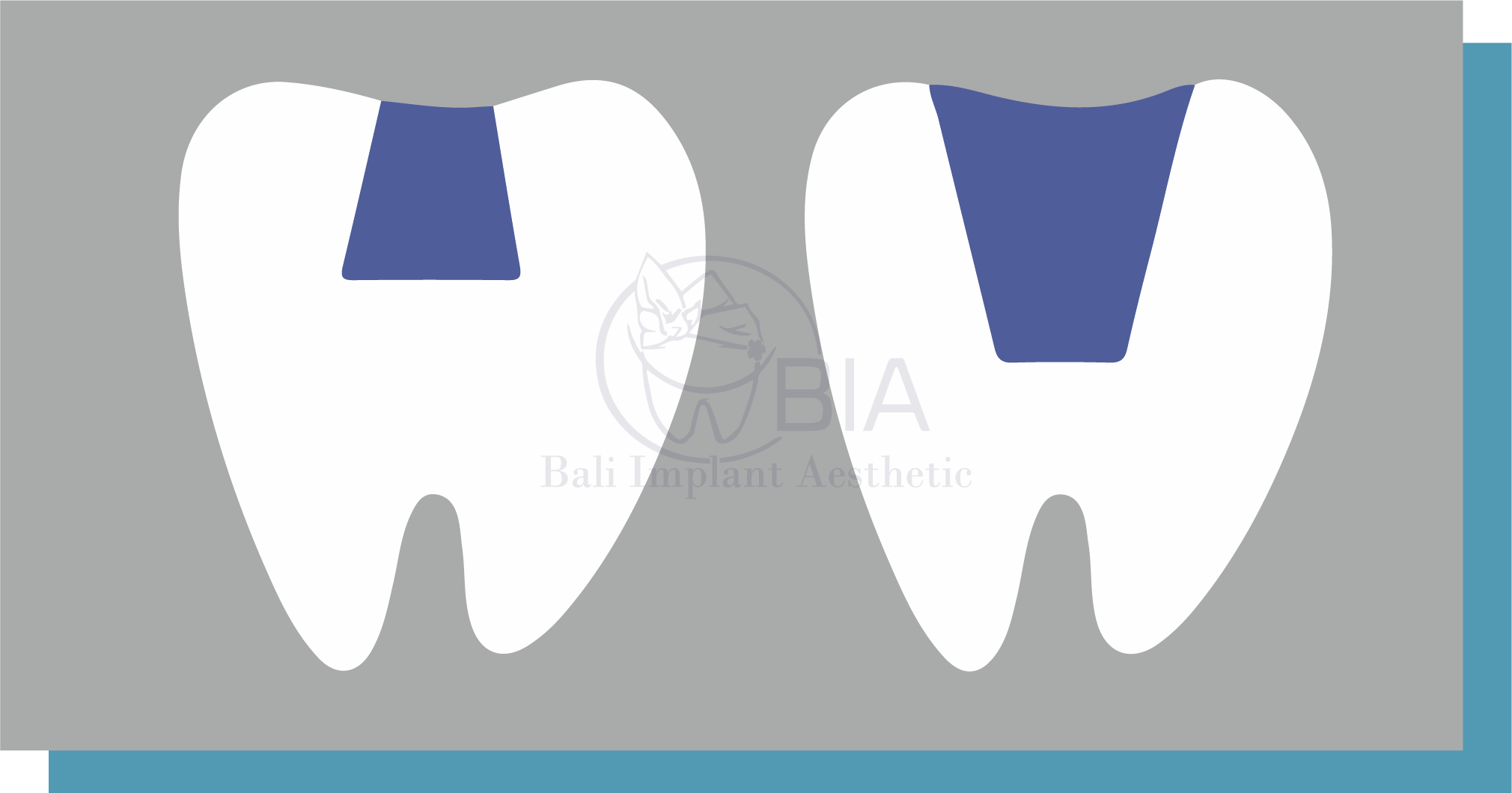 Blog Article Bia Dental