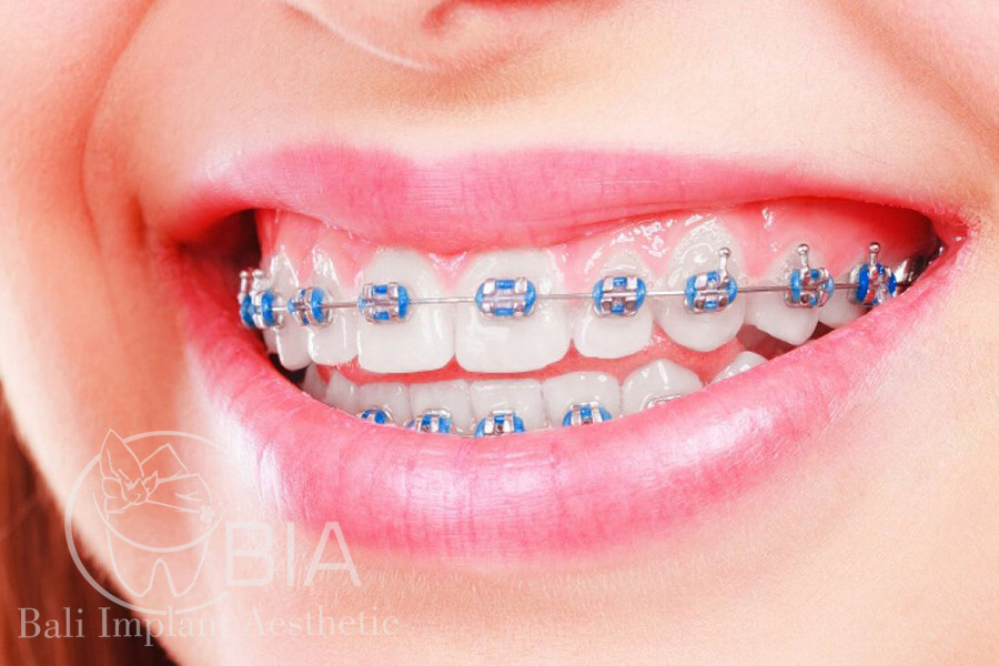 Blog Article Bia Dental