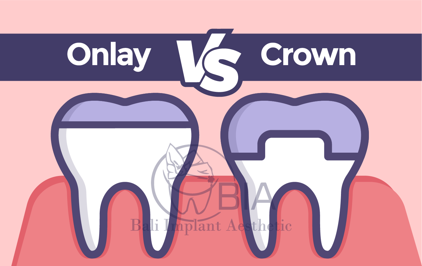 Blog Article Bia Dental