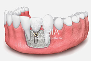 Blog Article Bia Dental