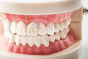Blog Article Bia Dental