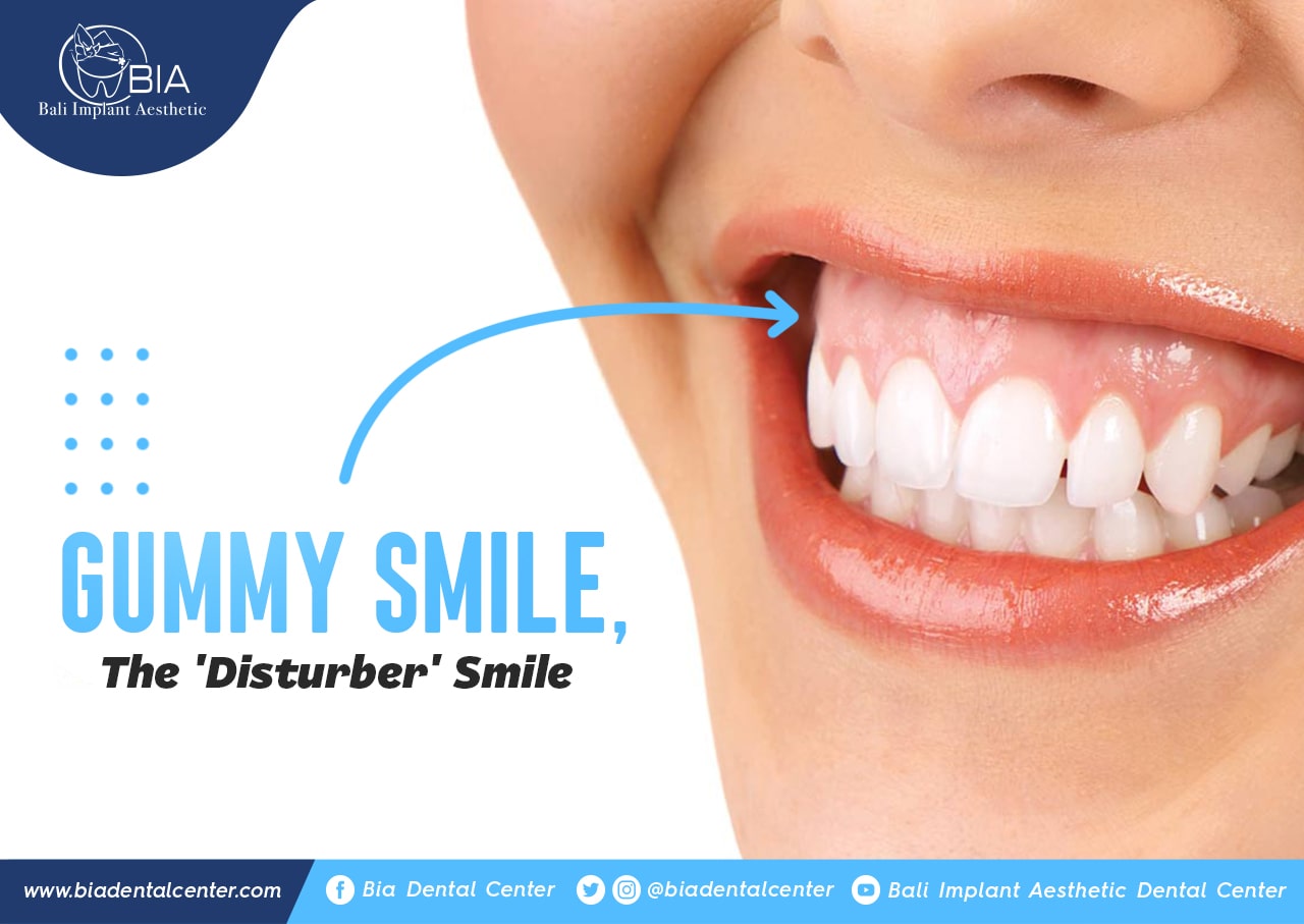 Blog Article Bia Dental
