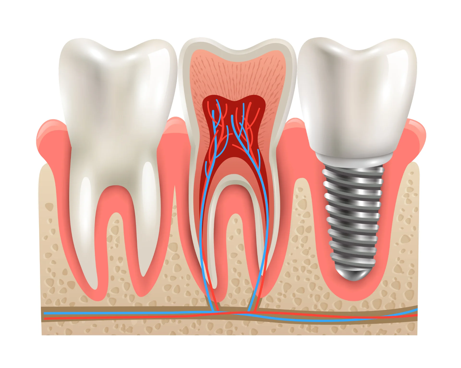 Bone Graft for Dental Implant