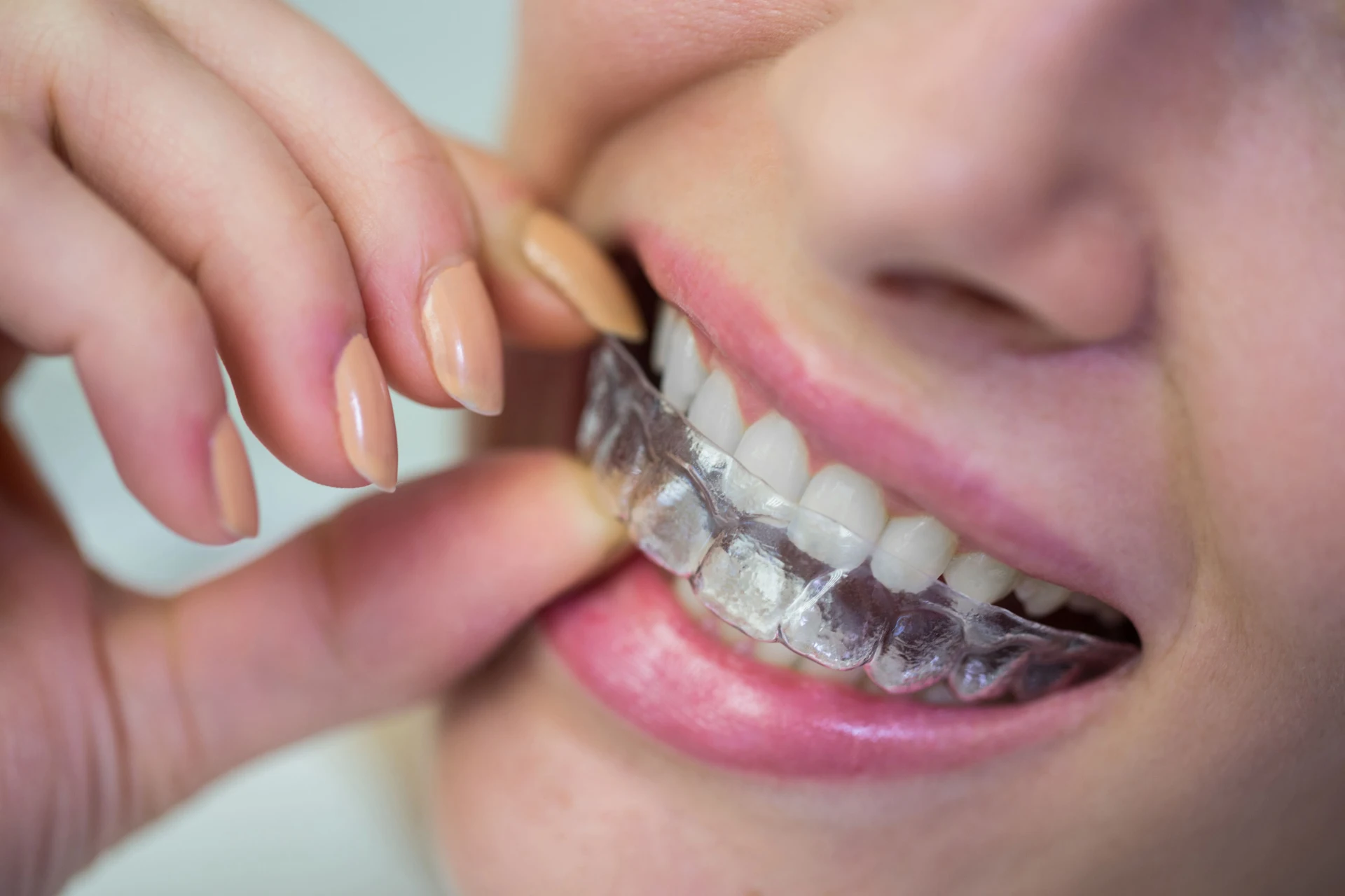 clear aligner vs braces