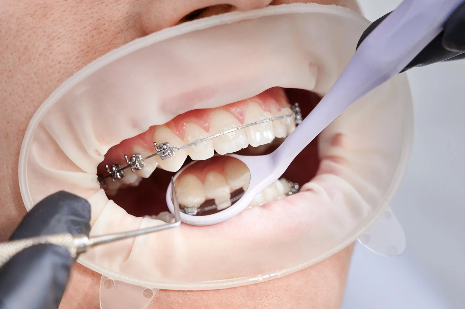 How long do braces take