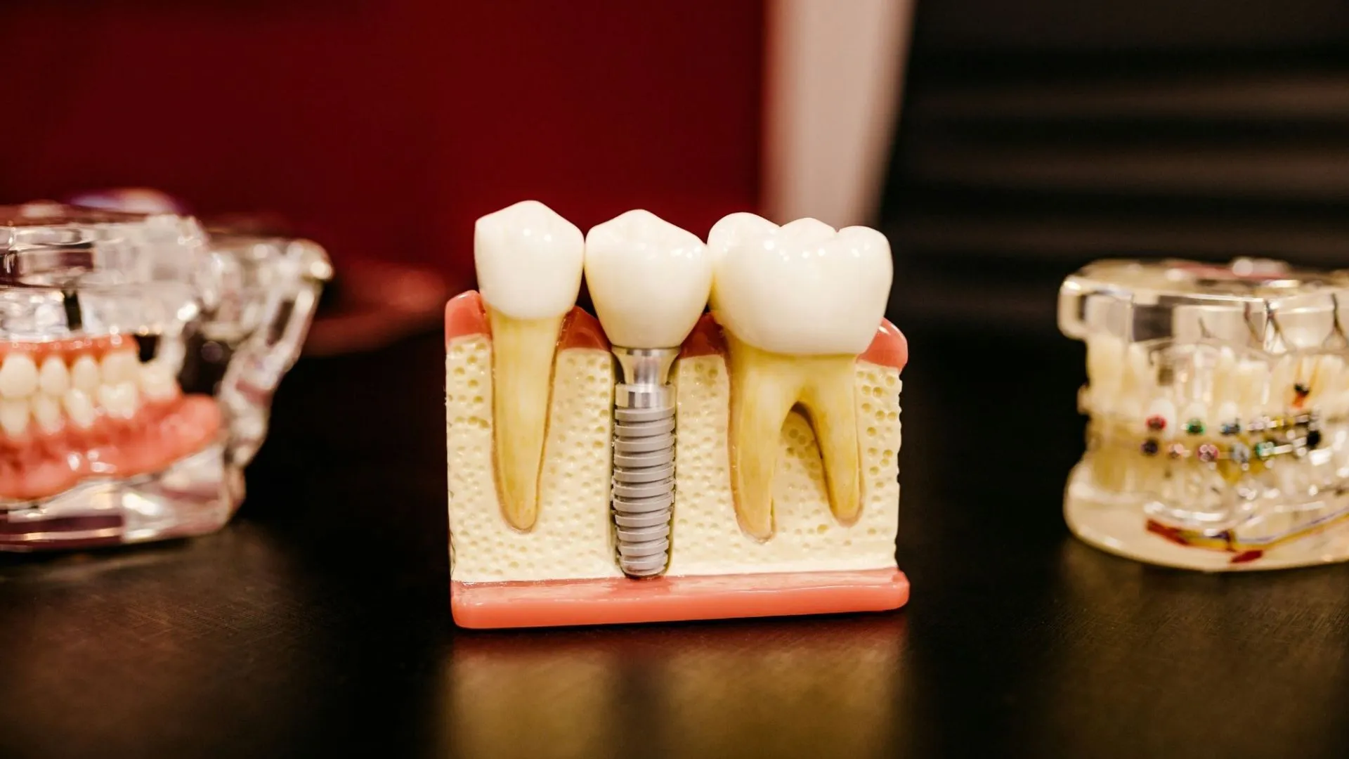 How to relieve pain from dental implant