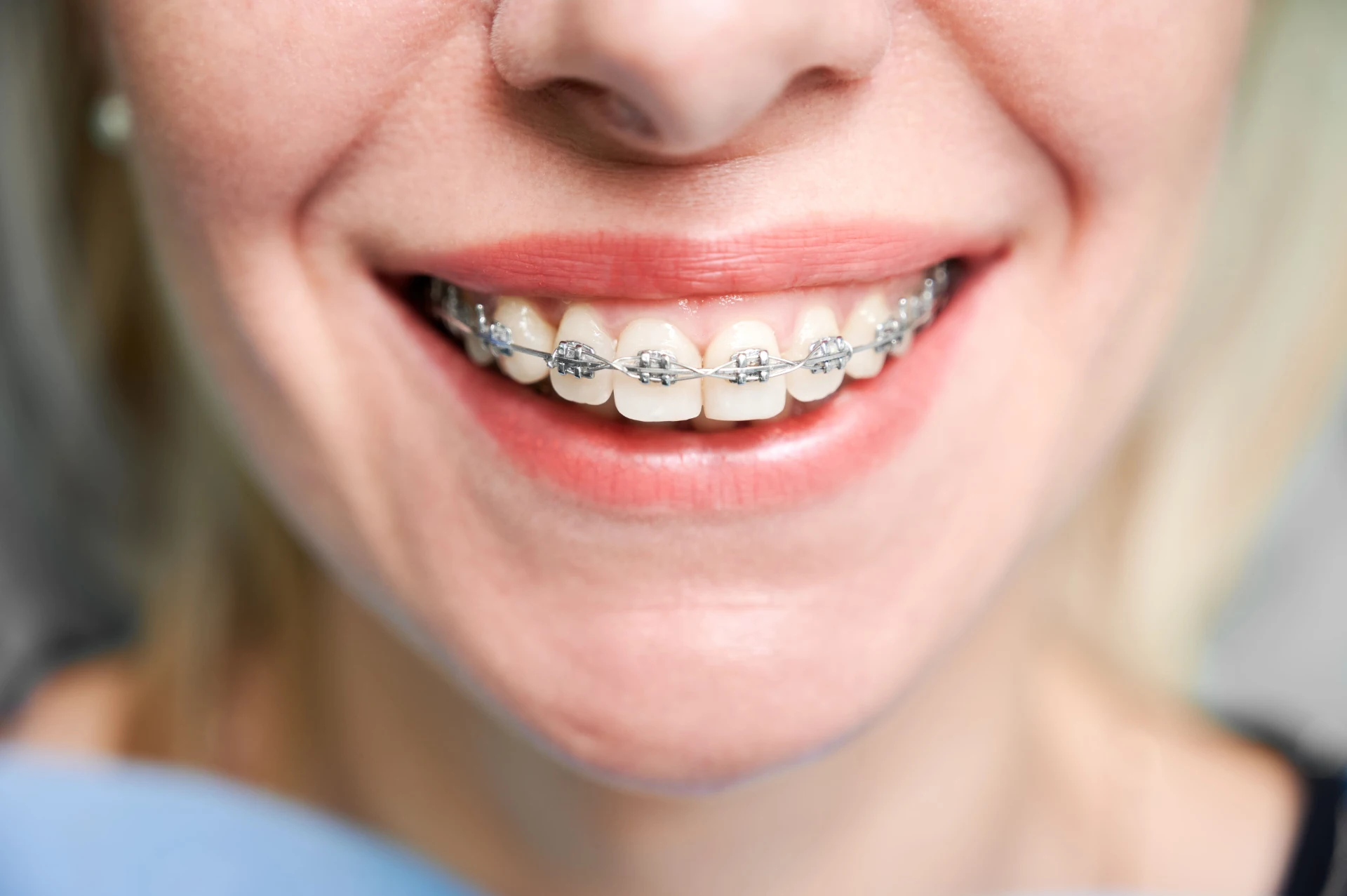Orthodontic Treatment for Crowded