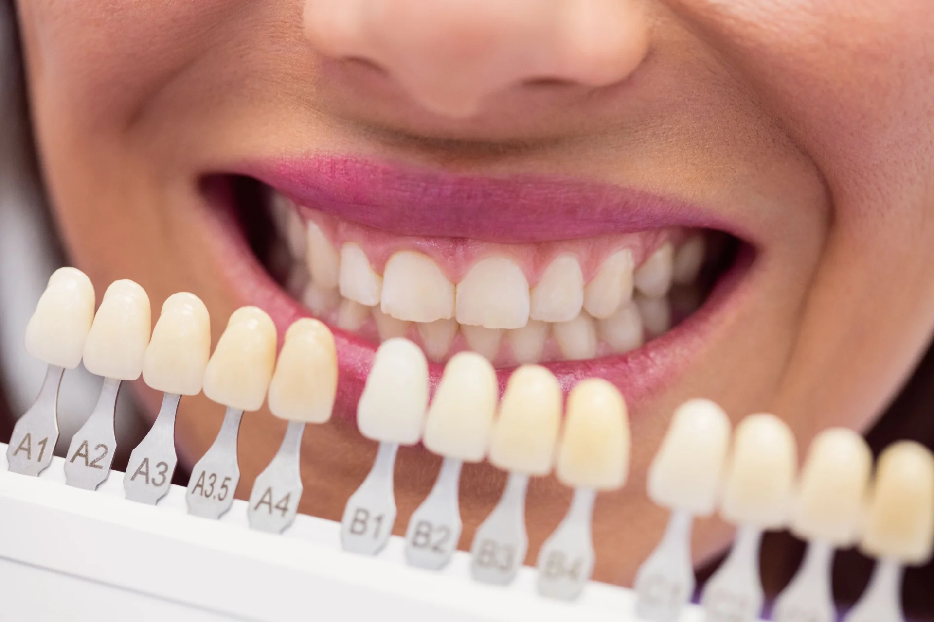 Porcelain Veneers: Everything You Need to Know