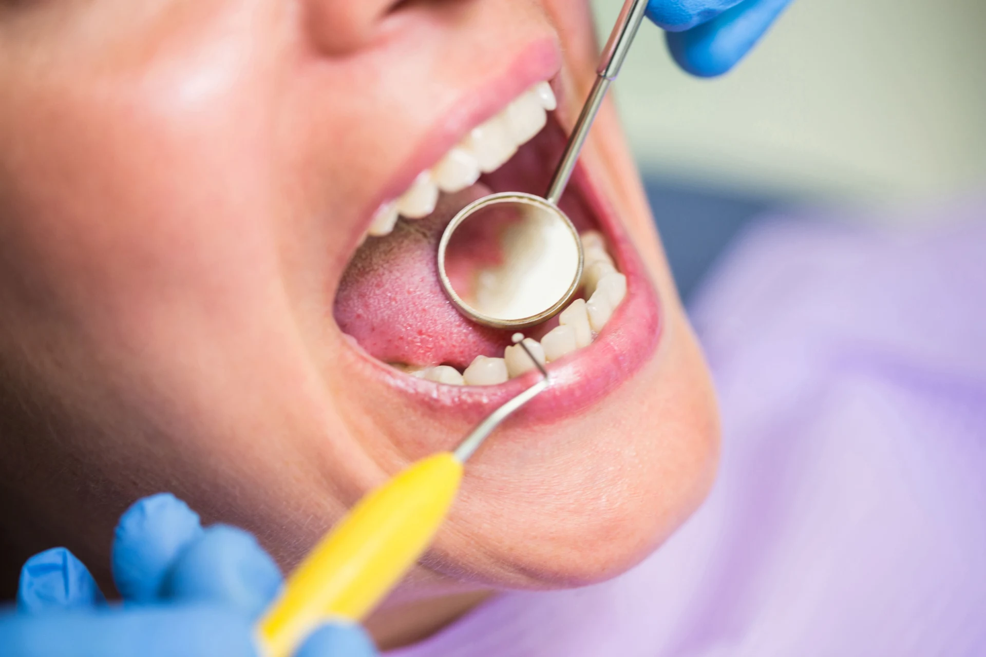 Teeth Scaling Side Effects