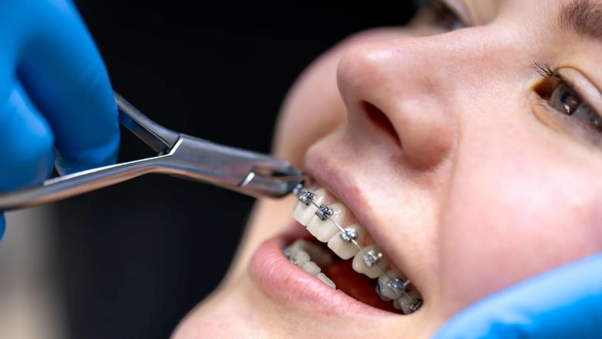 Braces installation