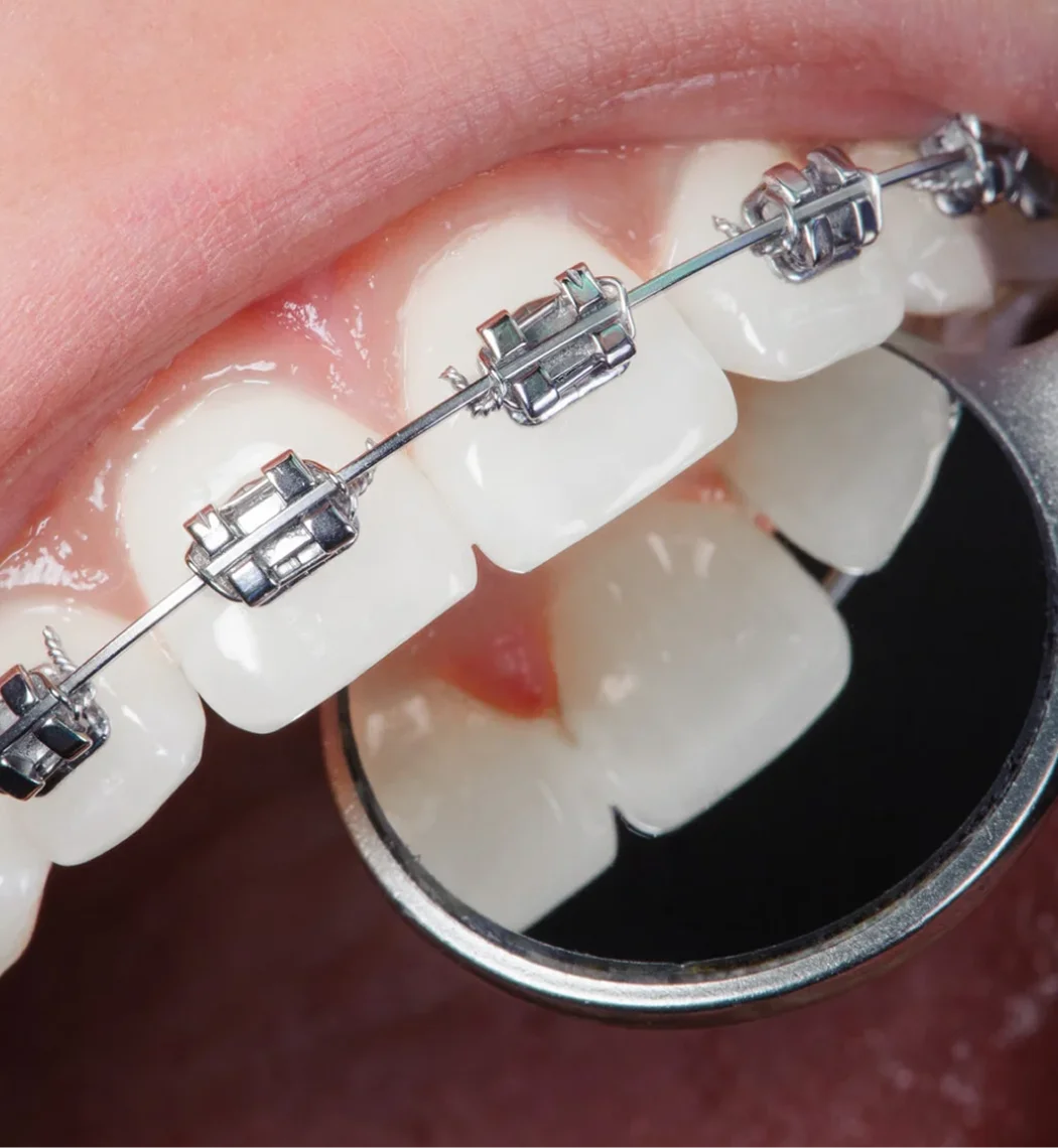 Braces Bia Dental