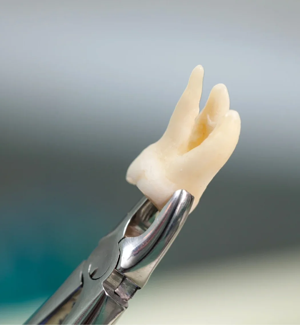 Dental Extraction Bia Dental