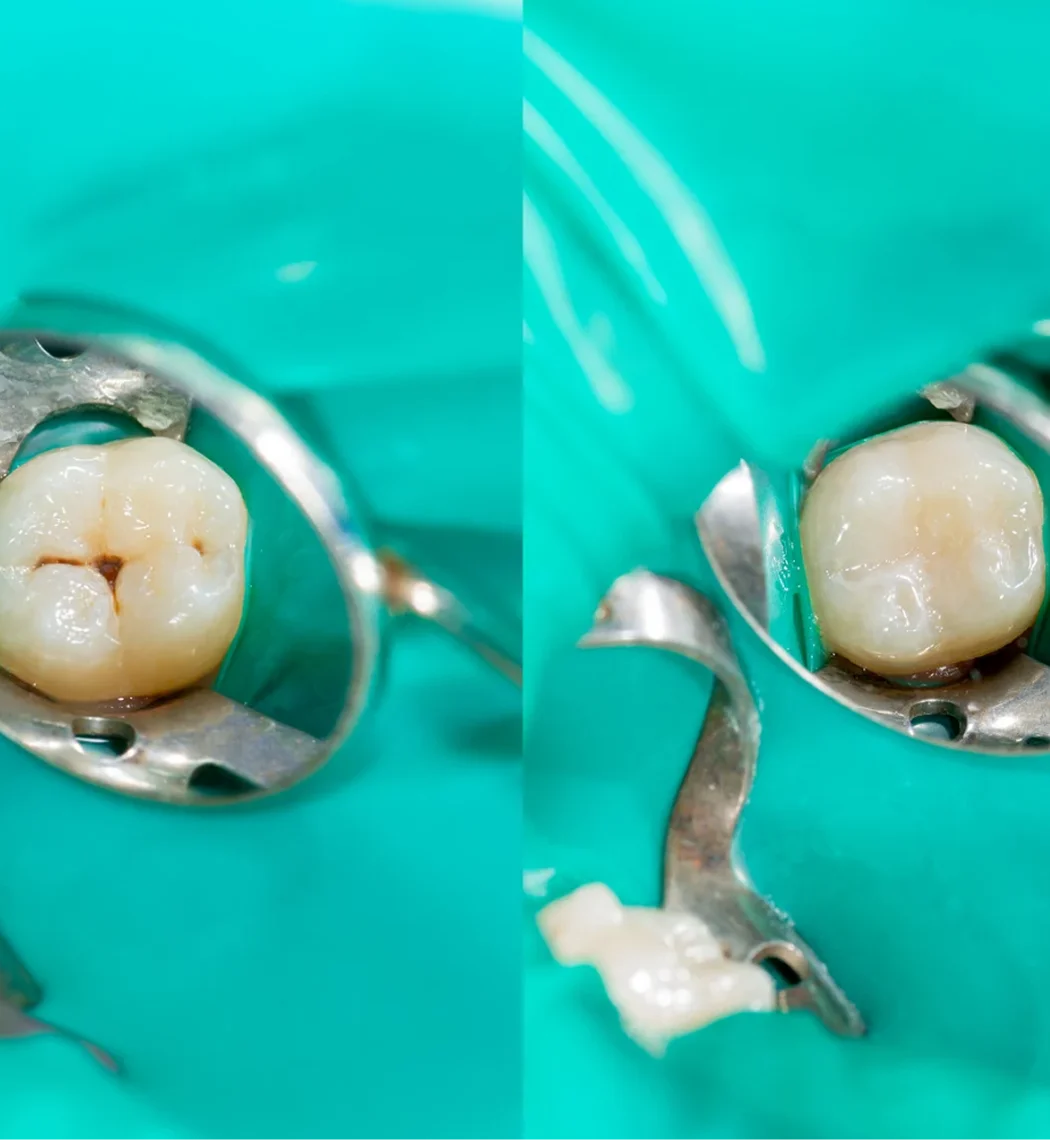 Dental Filling Bia Dental