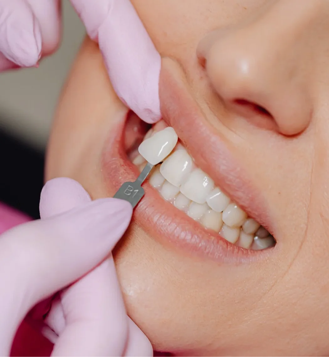 Direct Veneer Composite Bia Dental