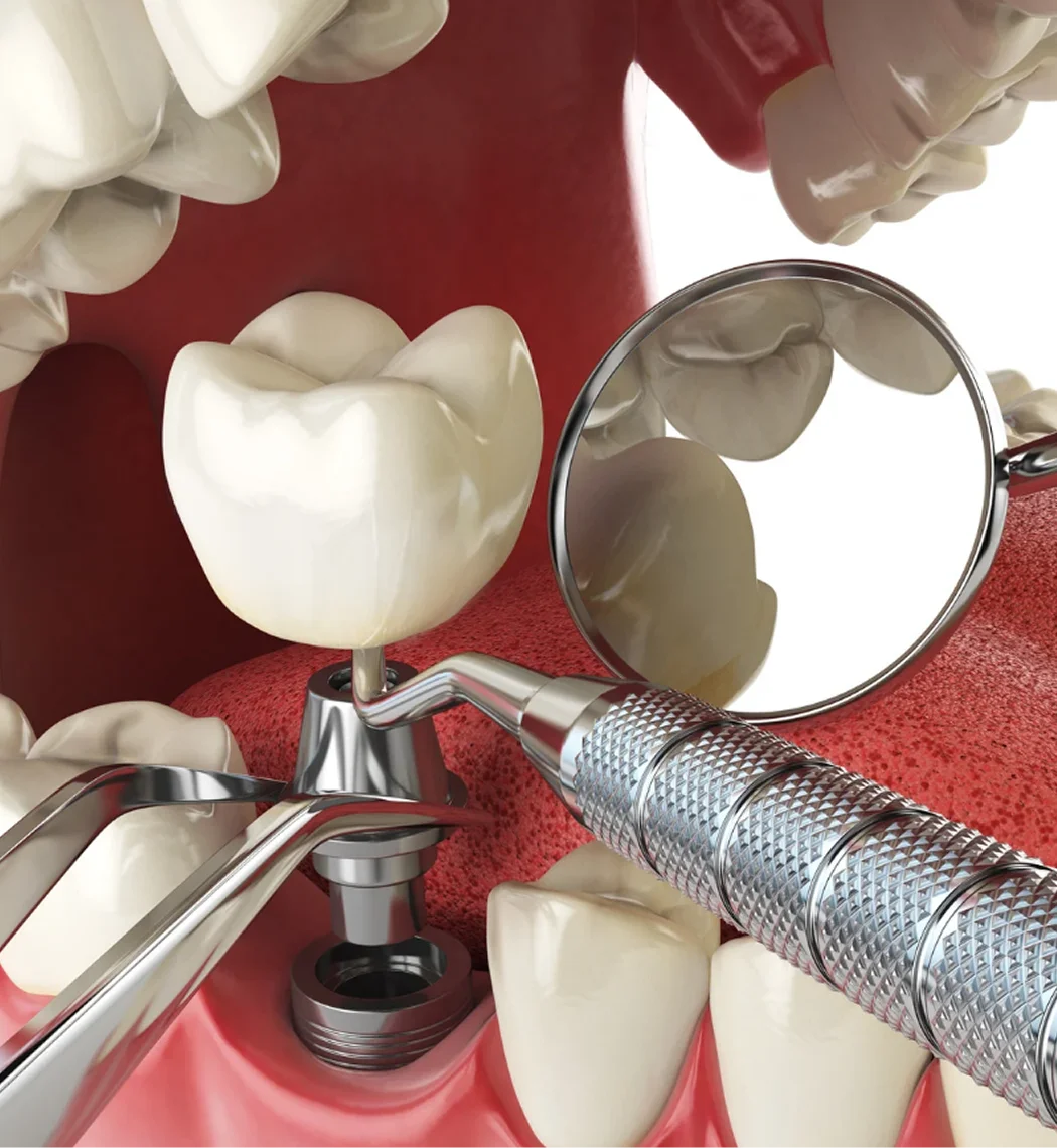 Full Mouth Dental Implant/All on 4/All on X Bia Dental