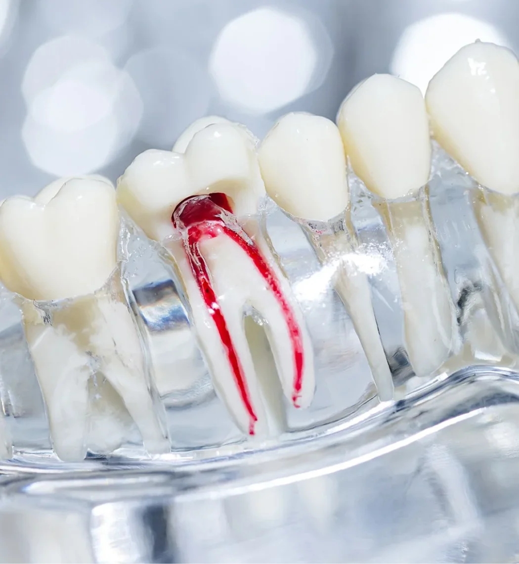 Root Canal Treatment Bia Dental
