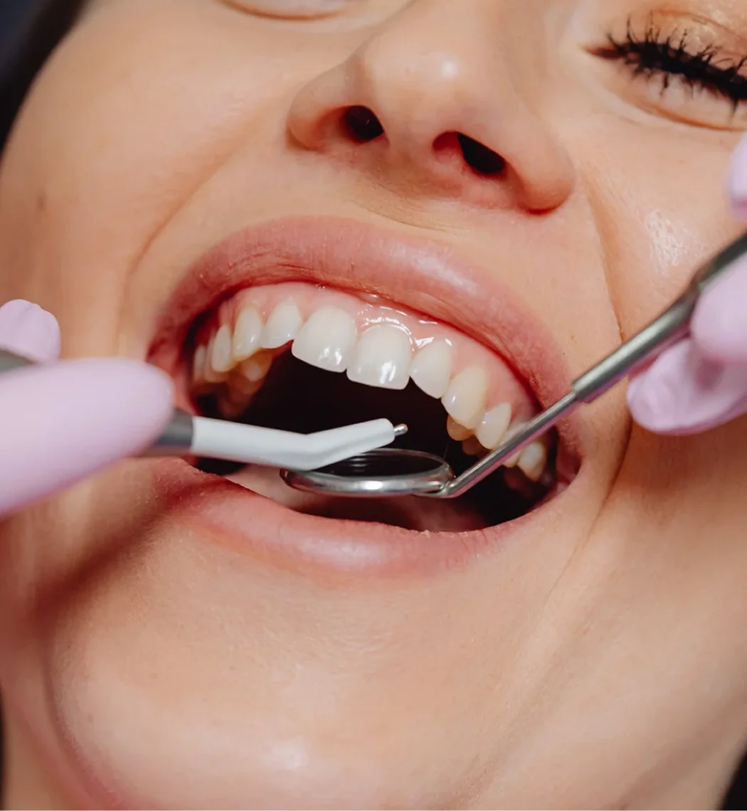 Scaling Bia Dental