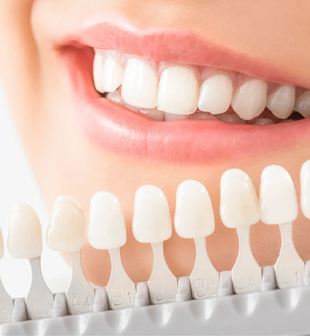 Teeth Whitening Bia Dental